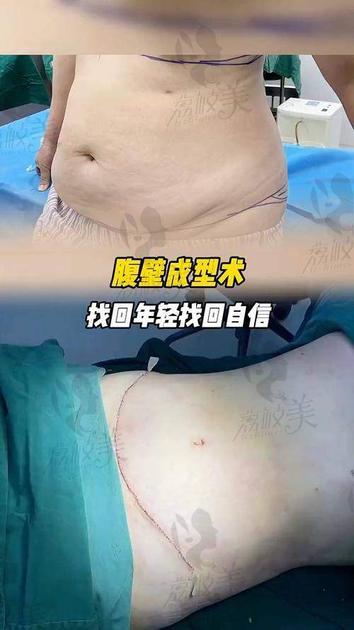 吸脂能“吸”出成绩？丛医生到底技术多绝？