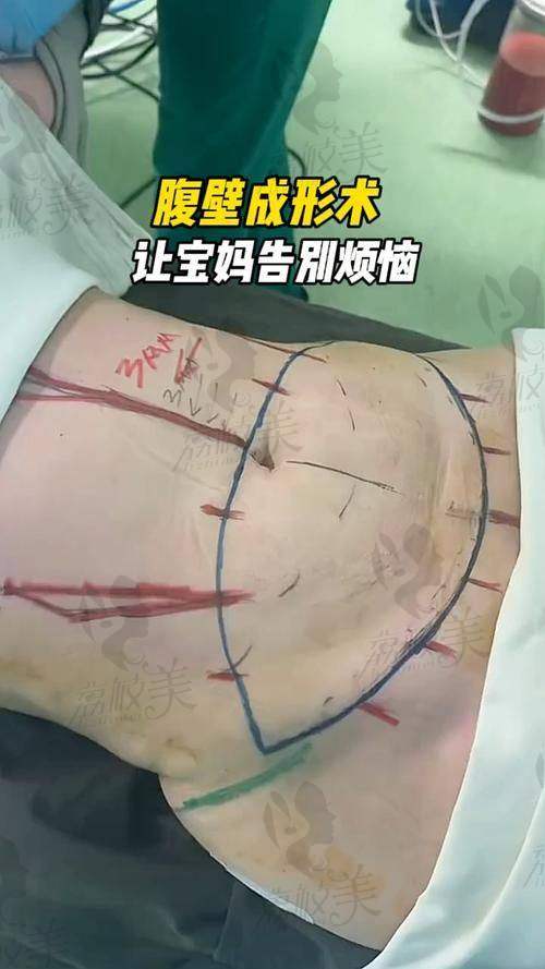1. 手术前的设计像做建筑蓝图一样严谨
