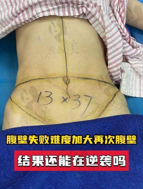 真实案例分享：术后效果好不好，看“老粉”怎么说