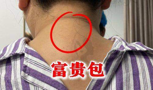 成都春天整形医院周斌富贵包祛除8800元起，专业技术助您轻松告别富贵包烦恼 