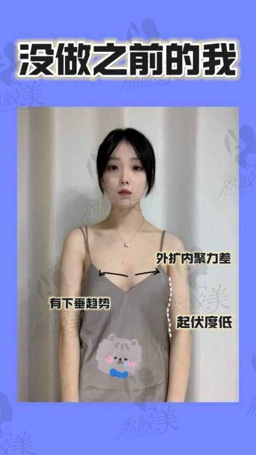 杭州艺星医生推荐:万连壮 —— 自体脂肪隆胸推荐医生