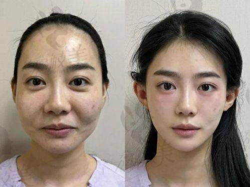 术后如何维稳？杨胤恒闭环式“抗馒化管理”了解一下！