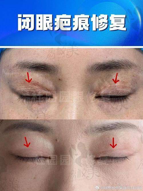 上海千美医疗美容门诊部 罗文婷医生韩式定点/埋线折叠法价格线