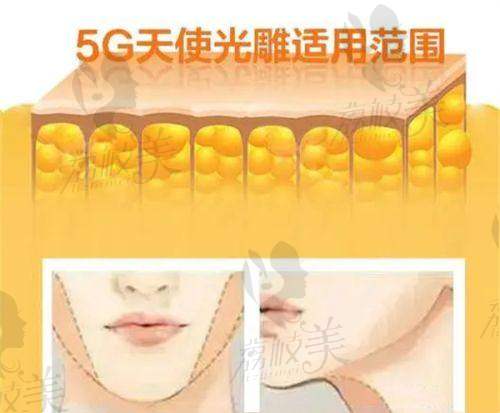 舒茂國(guó)整形醫(yī)生疤痕切縫多少錢(qián)？受疤痕情況等因素影響，2000 - 15000元不等 