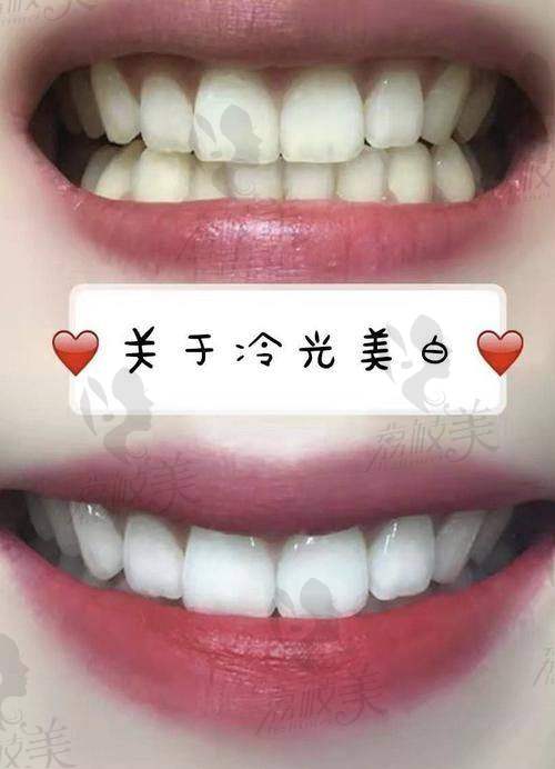 南通摩尔口腔牙齿美白真实体验