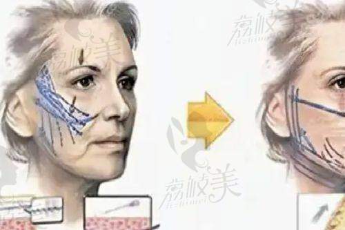 张菊兰医生技术特点:
