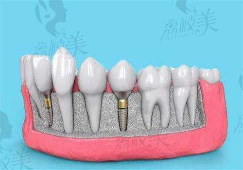 按牙齿部位划分的种植价格参考