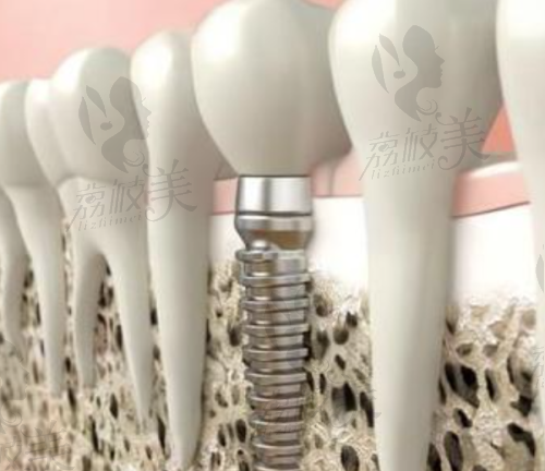 江门种植牙齿大概多少钱一颗?价格表揭秘!