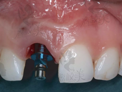 江门中医院种植牙费用及体验