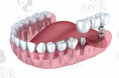 2. 多颗连桥种植牙
