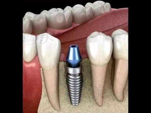 不同种植牙项目特点解析
