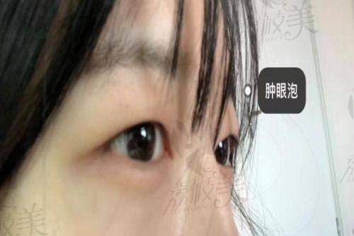 成都维星颜张春光医生双眼皮实例成效到底怎么样？真实反馈来说明