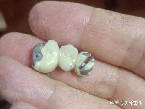 根管戴牙套大概多少钱?这里有价格参考