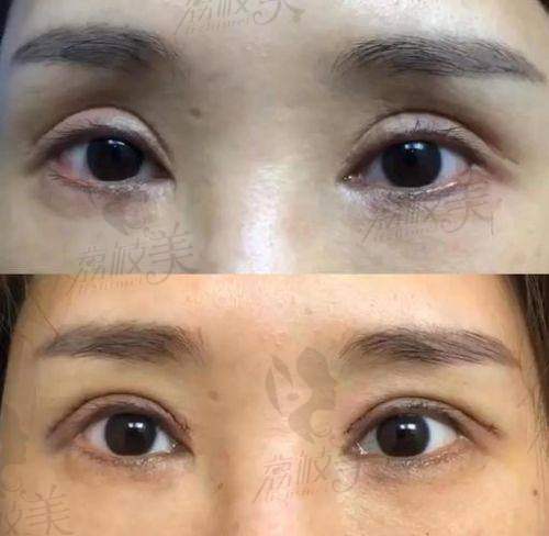 上海爱尚丽格医疗美容门诊双眼皮修复39800起,高难度眼修复技术一绝!