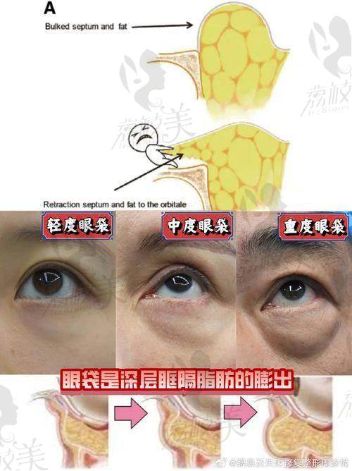 上海爱尚丽格张诗若做内眼角修复技术优势