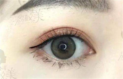 刘辅容眼修复价格表出炉！2026版各项目明细曝光，附野生实例效果惊人！