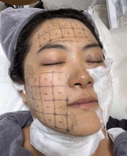 牛啦！海南海口会美医疗美容门诊部庞慧芬第5代热玛吉提升优势大揭秘