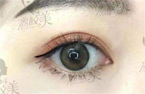 常德蔻妍医疗美容诊所:双眼皮手术的理想之选