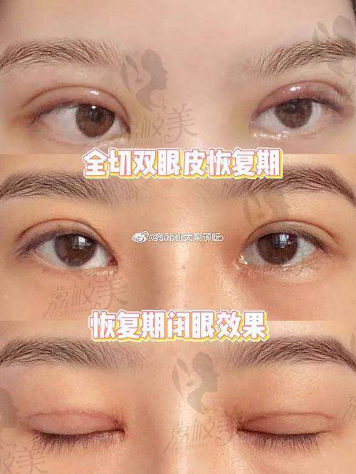 口碑爆棚:常德蔻妍杜克祥双眼皮的真实评价