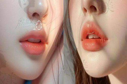 双十一特惠!嘉兴曙光内切眼袋1380元起,AAAAA级医院焕亮眼周无痕恢复快