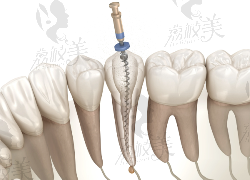 项目关键词解读：根管治疗880+的真实含义