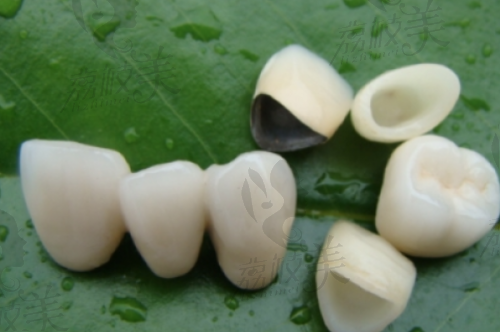 项目延展组合推荐:牙冠+补牙/根管更优惠