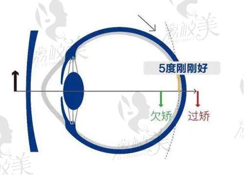 徐州华厦眼科 2025 补贴来袭！近视矫正 7800 元起，全飞秒 1.58 万起超划算