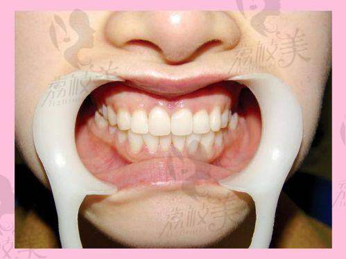 结语:从容貌到使用体验,牙冠修复不再遥不可及