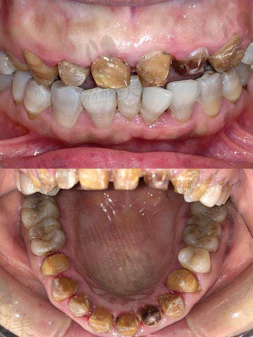 盐城中喜口腔牙冠修复收费888+轻松重塑咬合力，颜值口感双加分