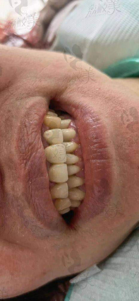 关键词搜索科普:牙冠修复指的是什么?适合哪些人?