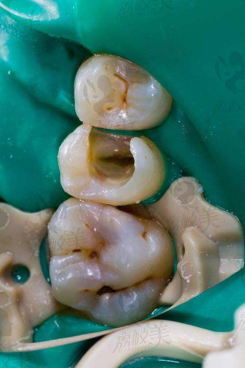 根管治疗项目，你了解多少？