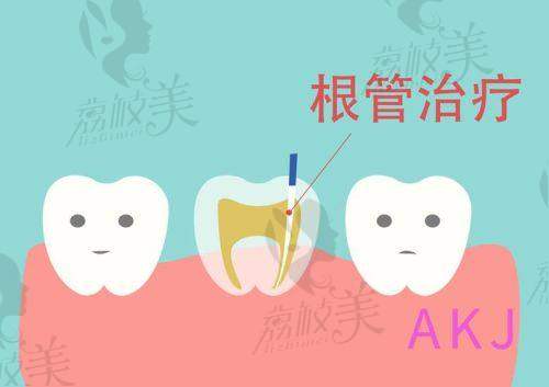 盐城中喜口腔医院根管治疗费用880+，舒适不痛还护牙·细致守护你的“牙”气人生