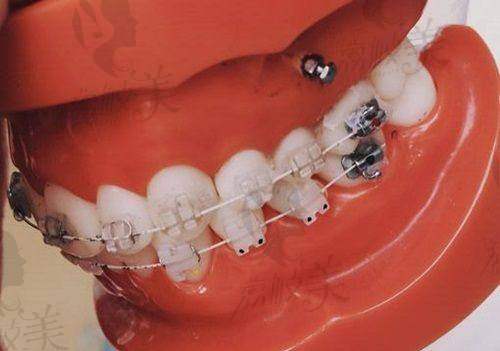 北大口腔林野医生:复杂种植修复骨干医生