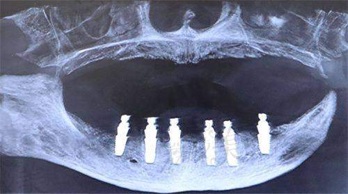 补牙多少钱一颗?