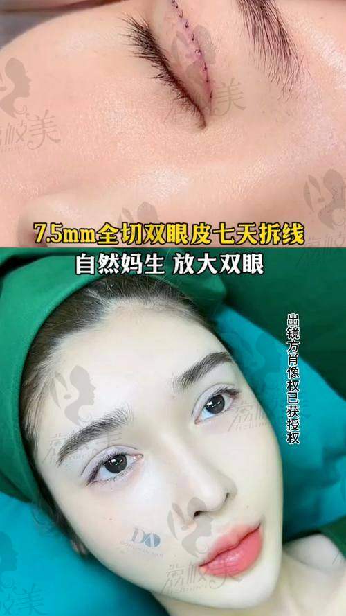 遵义韩美杨栋切开双眼皮:口碑爆棚,好评如潮!