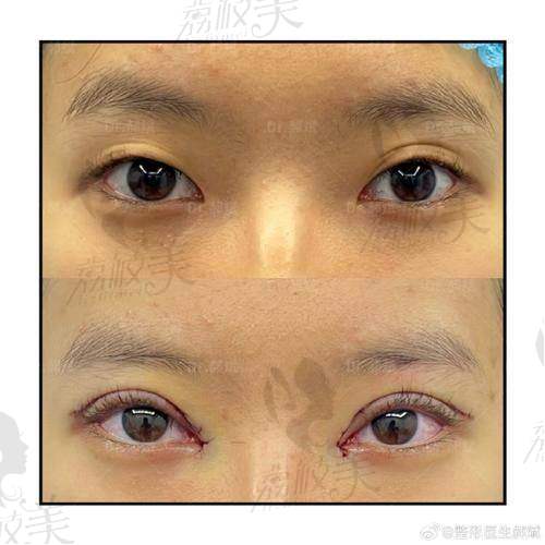 遵义韩美美容医院:切开双眼皮项目的坚强后盾!