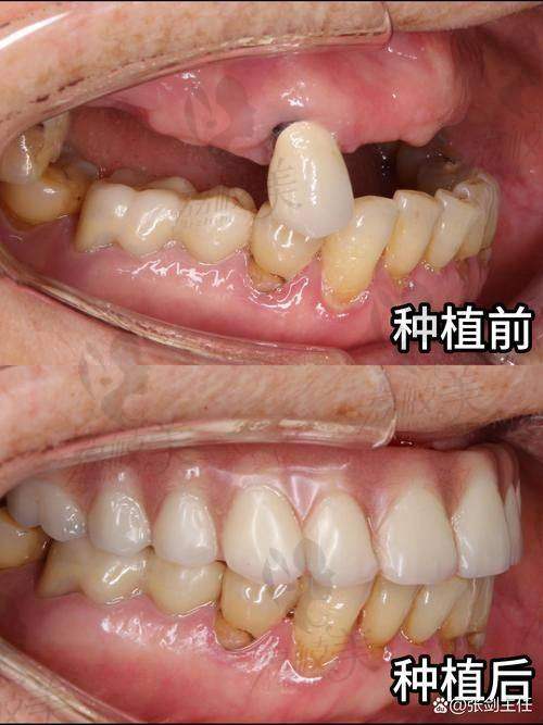 海沧医院牙科种植牙收费标准分析