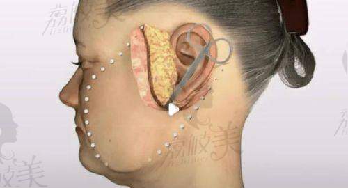 二、技术成熟吗?从“小切口拉皮”看杜太超的招牌操作