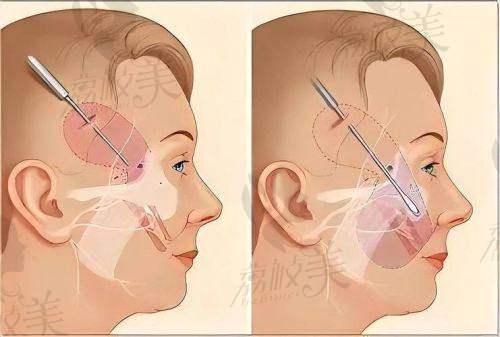 李正勇医生——「一站式」刷年轻值,大改造优选!