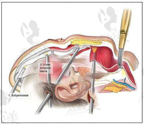 肖海涛医生——拉提界的“轮廓王者”,中年姐妹必收藏!