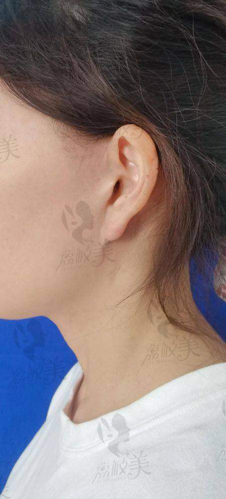 揭秘:华 西医院面部筋膜提升到底有没有“价格套路”?