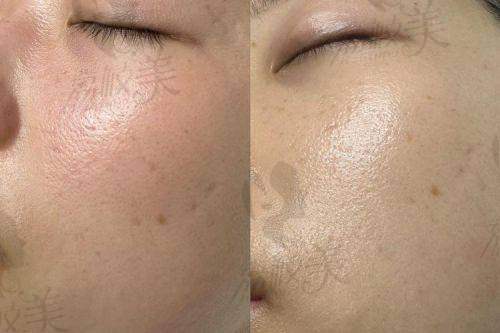 董薇薇医生技术特点: