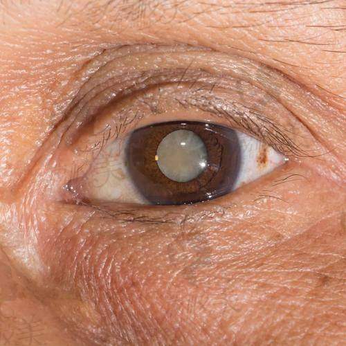 艾力坤医生主攻方向:“眼”技超群不是吹