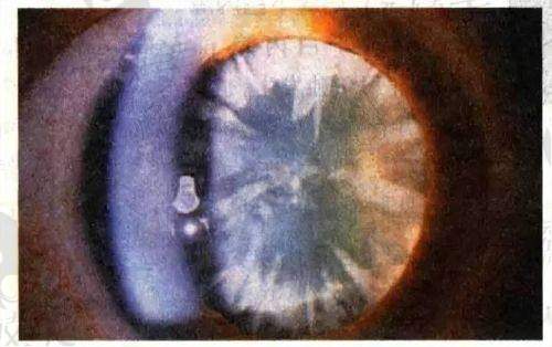 案例分享:他们在艾力坤医生这里“重获光明”!