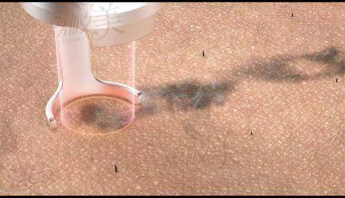 深圳南方门诊激光整形美容中 心价格表: